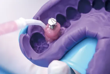 GumEasy™A-Silicone pour masque gingival: où la précision rencontre l'esthétique dans les restaurations d'implants