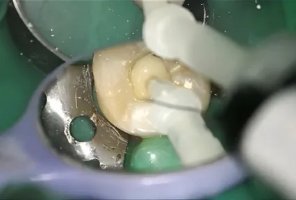 Reconstruction de noyau postérieur fiable avec UltraCore : Cas clinique sur la dent #37