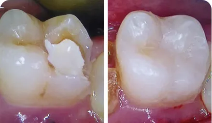 Restauration directe en composite de classe II de la dent #36 traitée endodontiquement