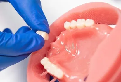 coût du matériau pour implant dentaire