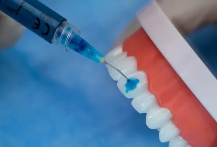 Gel de mordançage à l'acide phosphorique 37 % HUGE